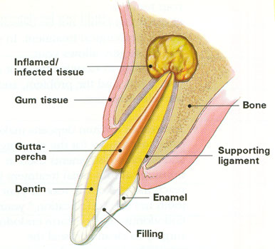 failed root canal